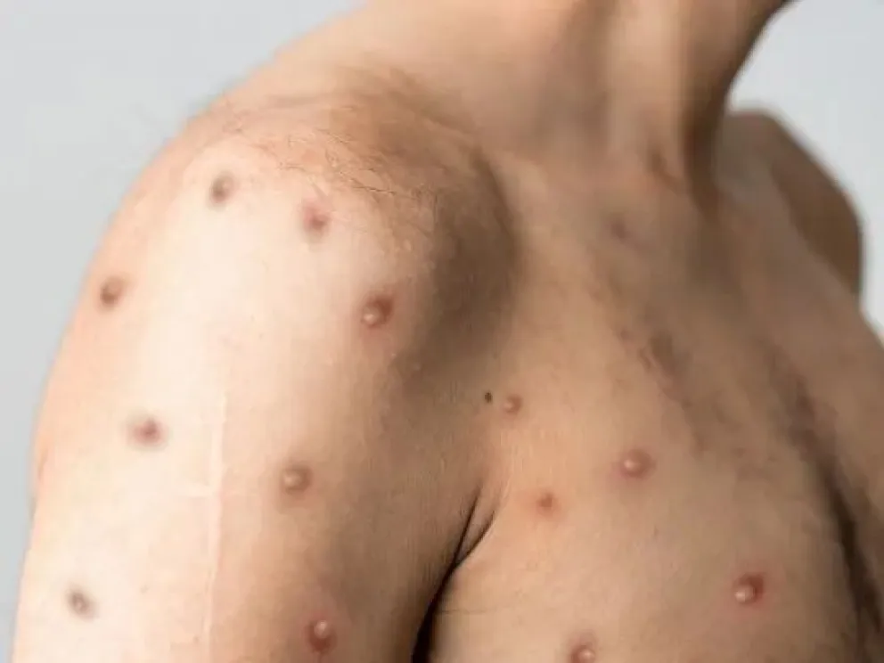 La Organización Mundial declaró la segunda emergencia sanitaria internacional en dos años. Foto: ilustrativa.