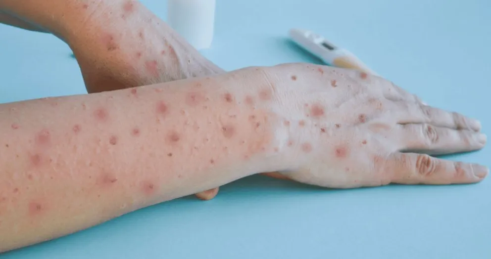 El virus see transmite por contacto directo con las lesiones cutáneas o mucosas de una persona infectada, incluyendo el contacto sexual.